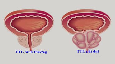 phì đại tiền liệt tuyến